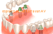  Имплантация зубов-зачем при небольших дефектах зубного ряда в Марьино 